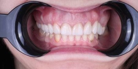 Замена не удовлетворительной ортопедической конструкции на новую керамическую реставрацию Замена не удовлетворительной ортопедической конструкции на новую керамическую реставрацию