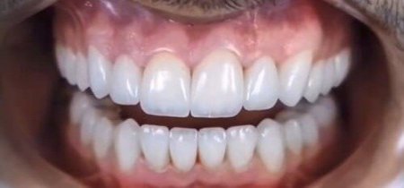 Восстановление эстетики и жевательной функции зубов Восстановление эстетики и жевательной функции зубов