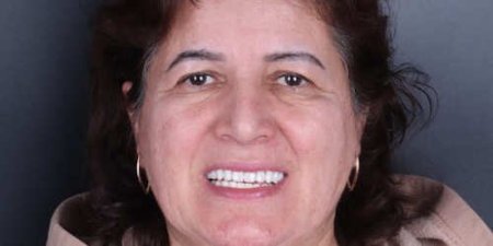 Тотальное восстановление жевательной функции зубов Тотальное восстановление жевательной функции зубов