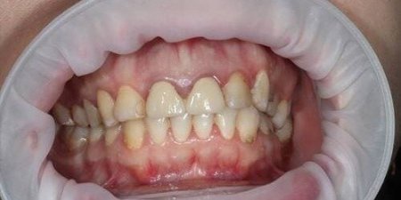 Замена не удовлетворительной ортопедической конструкции на новую керамическую реставрацию Замена не удовлетворительной ортопедической конструкции на новую керамическую реставрацию