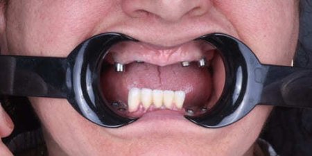 Тотальное восстановление жевательной функции зубов Тотальное восстановление жевательной функции зубов