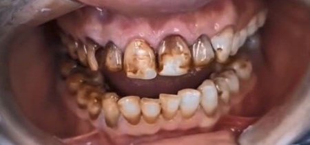 Восстановление эстетики и жевательной функции зубов Восстановление эстетики и жевательной функции зубов